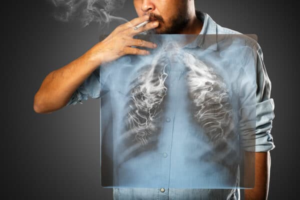 COPD – (chronisch obstruktive Lungenerkrankung)